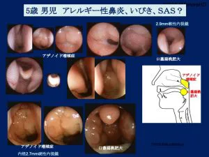 目で視る耳鼻咽喉科疾患（内視鏡所見） | 山口内科耳鼻咽喉科