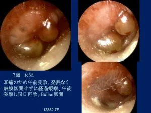 目で視る耳鼻咽喉科疾患（内視鏡所見） | 山口内科耳鼻咽喉科